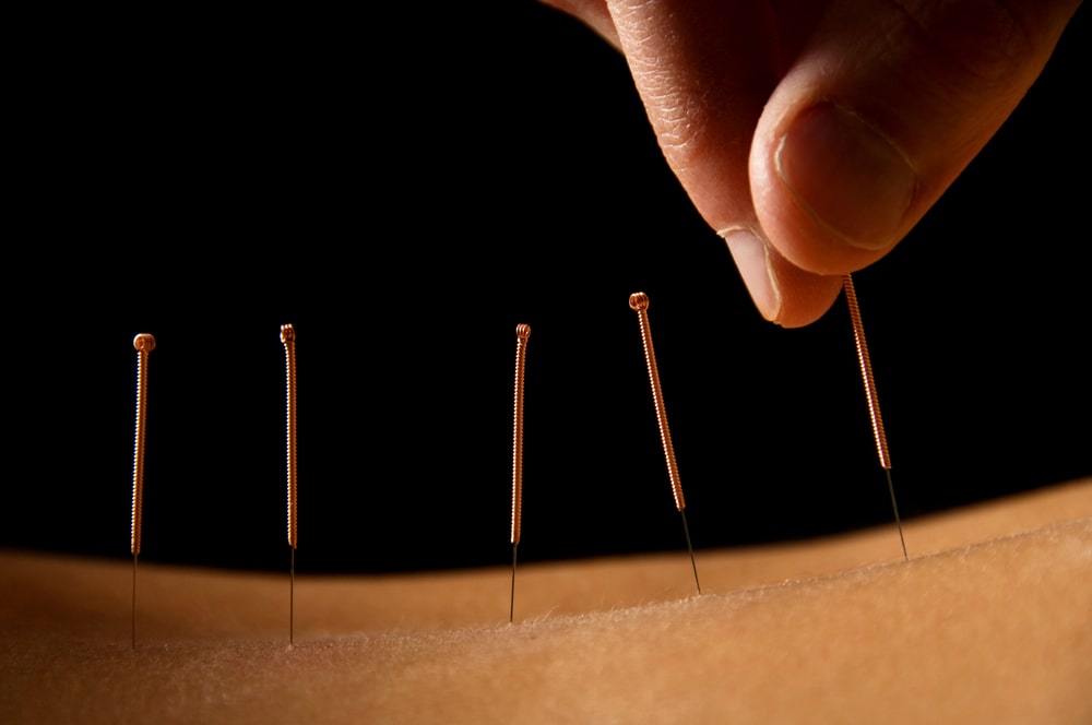 acupuncture Lake Zurich, IL